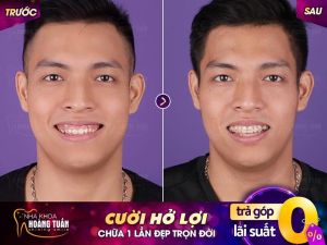 Hình ảnh điều trị cười hở lợi của KH Lưu Tiến Hoàng – Nha khoa Dr Hoàng Tuấn – Ca 1