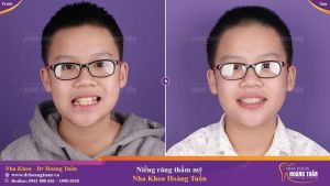 Hình ảnh niềng răng mắc cài của KH 14 tuổi – Nha khoa Dr Hoàng Tuấn – Ca 10