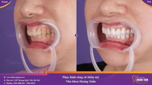 Hình ảnh bọc răng sứ - Nha khoa Dr Hoàng Tuấn – Ca 11