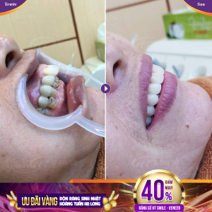 Hình ảnh bọc răng sứ - Nha khoa Dr Hoàng Tuấn – Ca 12