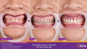Hình ảnh niềng răng mắc cài của KH 50 tuổi – Nha khoa Dr Hoàng Tuấn – Ca 13
