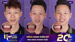 Hình ảnh niềng răng mắc cài của KH Lò Văn Bình – Nha khoa Dr Hoàng Tuấn – Ca 14
