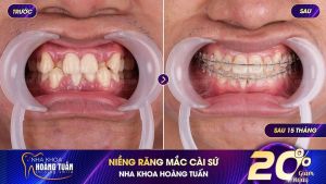 Hình ảnh niềng răng mắc cài của KH 26 tuổi – Nha khoa Dr Hoàng Tuấn – Ca 15