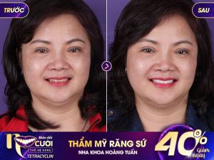 Hình ảnh bọc răng sứ của KH Nguyễn Thị Kim Thanh – Nha khoa Dr Hoàng Tuấn – Ca 16