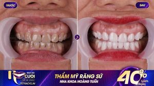 Hình ảnh bọc răng sứ - Nha khoa Dr Hoàng Tuấn – Ca 17