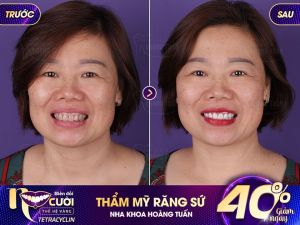 Hình ảnh bọc răng sứ của KH Nguyễn Thị Thinh – Nha khoa Dr Hoàng Tuấn – Ca 18