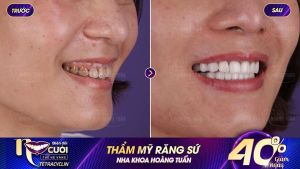 Hình ảnh bọc răng sứ của KH Trần Thị Thu Hương – Nha khoa Dr Hoàng Tuấn – Ca 19