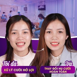 Hình ảnh điều trị cười hở lợi của KH Mạ Thị Hoa – Nha khoa Dr Hoàng Tuấn – Ca 2