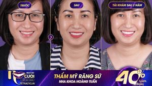 Hình ảnh bọc răng sứ của KH Ngô Ngọc Nương – Nha khoa Dr Hoàng Tuấn – Ca 20