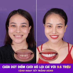 Hình ảnh điều trị cười hở lợi – Nha khoa Dr Hoàng Tuấn – Ca 21