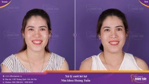 Hình ảnh điều trị cười hở lợi – Nha khoa Dr Hoàng Tuấn – Ca 22