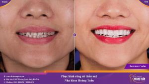 Hình ảnh bọc răng sứ của chị Huyền – Nha khoa Dr Hoàng Tuấn – Ca 23