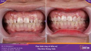 Hình ảnh bọc răng sứ - Nha khoa Dr Hoàng Tuấn – Ca 24