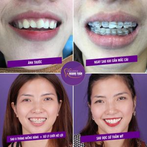 Hình ảnh bọc răng sứ và điều trị cười hở lợi của KH Kim Chung – Nha khoa Dr Hoàng Tuấn – Ca 3