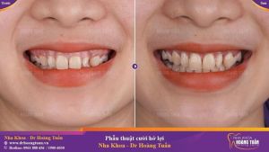 Hình ảnh điều trị cười hở lợi – Nha khoa Dr Hoàng Tuấn – Ca 4