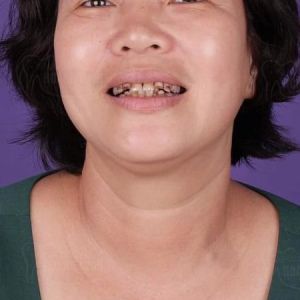 Hình ảnh bọc răng sứ - Nha khoa Dr Hoàng Tuấn – Ca 5