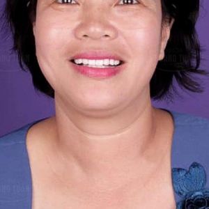 Hình ảnh bọc răng sứ - Nha khoa Dr Hoàng Tuấn – Ca 5