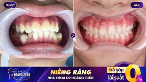 Hình ảnh niềng răng mắc cài – Nha khoa Dr Hoàng Tuấn – Ca 6
