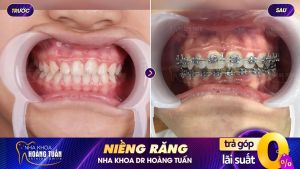 Hình ảnh niềng răng mắc cài – Nha khoa Dr Hoàng Tuấn – Ca 7
