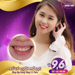 Hình ảnh điều trị cười hở lợi – Nha khoa Dr Hoàng Tuấn – Ca 8