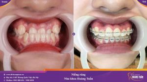 Hình ảnh niềng răng mắc cài – Nha khoa Dr Hoàng Tuấn – Ca 9