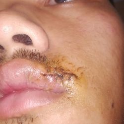 Cắt chỉ quá hạn ạ