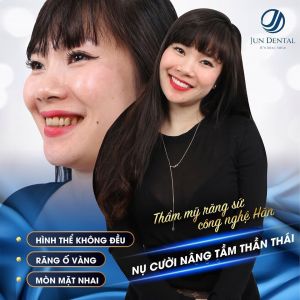 Hình ảnh bọc răng sứ của KH Đặng Thị Minh Hiến – Nha khoa Thẩm mỹ Quốc tế Jun Dental – Ca 1