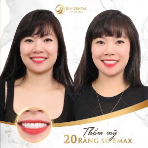 Hình ảnh bọc răng sứ - Nha khoa Thẩm mỹ Quốc tế Jun Dental – Ca 10
