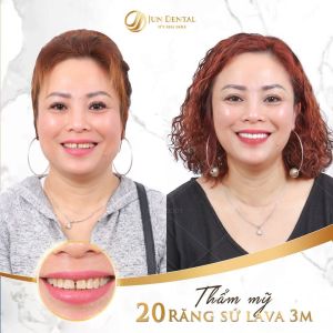 Hình ảnh bọc răng sứ - Nha khoa Thẩm mỹ Quốc tế Jun Dental – Ca 12