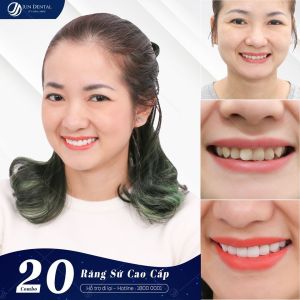 Hình ảnh bọc răng sứ của chị Uyên – Nha khoa Thẩm mỹ Quốc tế Jun Dental – Ca 13