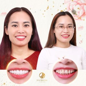 Hình ảnh bọc răng sứ của KH Nguyễn Thu Huyền – Nha khoa Thẩm mỹ Quốc tế Jun Dental – Ca 14