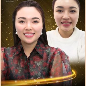 Hình ảnh bọc răng sứ của KH My – Nha khoa Thẩm mỹ Quốc tế Jun Dental – Ca 15