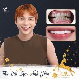 Hình ảnh bọc răng sứ của Tùng Teejay – Nha khoa Thẩm mỹ Quốc tế Jun Dental – Ca 17