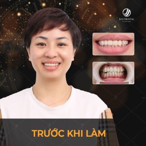 Hình ảnh bọc răng sứ - Nha khoa Thẩm mỹ Quốc tế Jun Dental – Ca 18