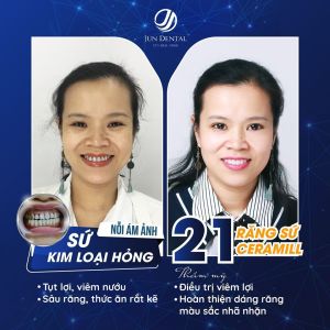 Hình ảnh bọc răng sứ của KH Đặng Hải Hà – Nha khoa Thẩm mỹ Quốc tế Jun Dental – Ca 2