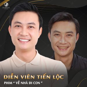 Hình ảnh bọc răng sứ của Diễn viên Tiến Lộc – Nha khoa Thẩm mỹ Quốc tế Jun Dental – Ca 20