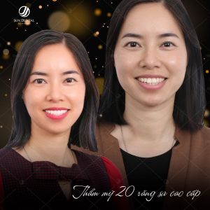 Hình ảnh bọc răng sứ - Nha khoa Thẩm mỹ Quốc tế Jun Dental – Ca 21