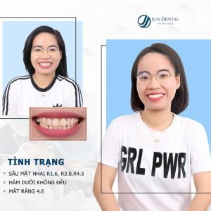 Hình ảnh bọc răng sứ - Nha khoa Thẩm mỹ Quốc tế Jun Dental – Ca 22