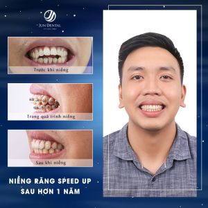Hình ảnh niềng răng mắc cài - Nha khoa Thẩm mỹ Quốc tế Jun Dental – Ca 23