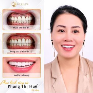 Hình ảnh bọc răng sứ của KH Phùng Thị Huế - Nha khoa Thẩm mỹ Quốc tế Jun Dental – Ca 24