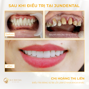 Hình ảnh bọc răng sứ của KH Đào Thị Gấm – Nha khoa Thẩm mỹ Quốc tế Jun Dental – Ca 25