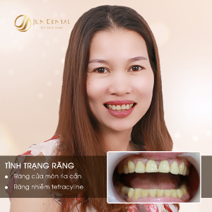 Hình ảnh bọc răng sứ của KH Hoàng Thị Liên – Nha khoa Thẩm mỹ Quốc tế Jun Dental – ca 26