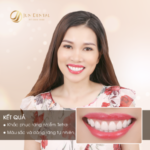 Hình ảnh bọc răng sứ của kH Lê Phương – Nha khoa Thẩm mỹ Quốc tế Jun Dental – Ca 26
