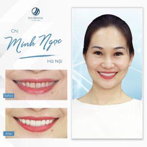 Hình ảnh bọc răng sứ của KH Minh Ngọc – Nha khoa Thẩm mỹ Quốc tế Jun Dental – Ca 27