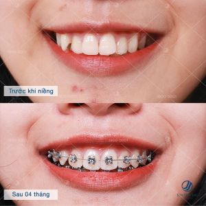 Hình ảnh niềng răng mắc cài của KH Thu Ngân – Nha khoa Thẩm mỹ Quốc tế Jun Dental – Ca 28