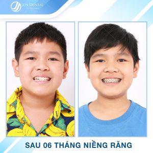 Hình ảnh niềng răng mắc cài của bé Lại Tuấn Dũng – Nha khoa Thẩm mỹ Quốc tế Jun Dental – Ca 29