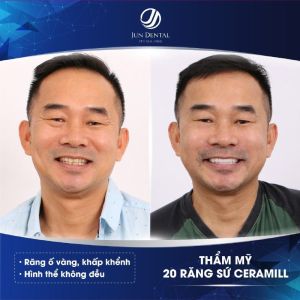 Hình ảnh bọc răng sứ của KH Vũ Viết Trọng – Nha khoa Thẩm mỹ Quốc tế Jun Dental – Ca 3