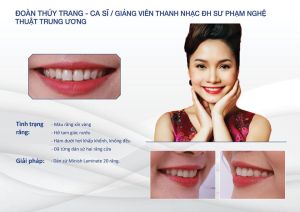Hình ảnh dán sứ của KH Đoàn Thúy Trang – Nha khoa Thẩm mỹ Quốc tế Jun Dental – Ca 30