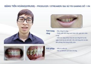 Hình ảnh dán sứ của Đặng Tiến Hoàng – Nha khoa Thẩm mỹ Quốc tế Jun Dental – Ca 31