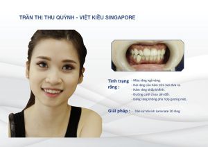 Hình ảnh dán sứ của Trần Thị Thu Quỳnh – Nha khoa Thẩm mỹ Quốc tế Jun Dental – Ca 32